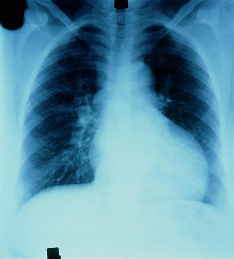 left ventricular hypertrophy x ray